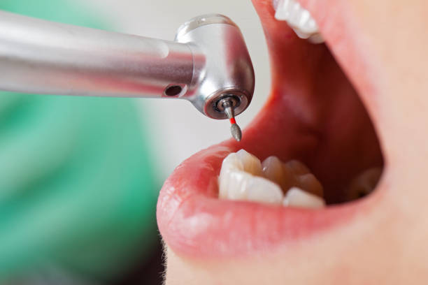 Best Emergency Treatment for Dental Infections or Abscesses in Pinewood Estates, TX
